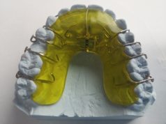 Cand este nevoie de un aparat dentar? clinica dentara Elveto Dent