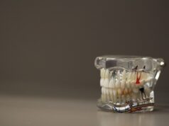 Tratamentul canalului radicular – tratamente stomatologice clinica stomatologica din sector 6