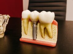 Etapele inserarii unui implant dentar extractie de masea