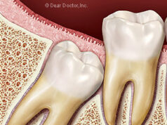 Care sunt simptomele specifice unei masea de minte cu probleme?