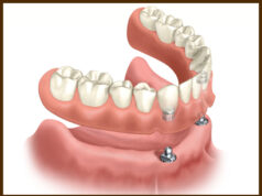 Iata cum te pot ajuta protezele dentare sa-ti imbunatatesti aspectul! protezele dentare