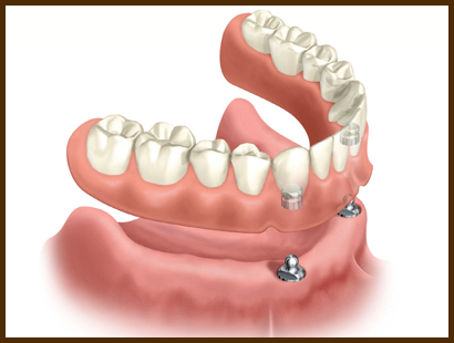 proteze-dentare-in-sector-2 protezele dentare