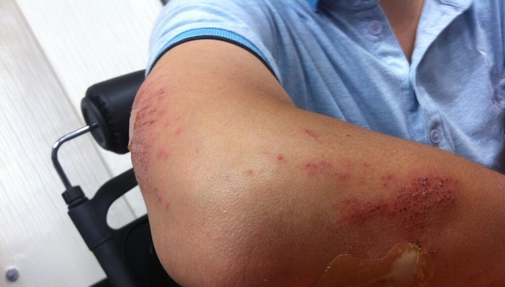 Epicondilita laterală