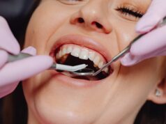 În cât timp se fac fațetele dentare? Fațetele dentare