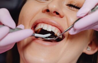 În cât timp se fac fațetele dentare? Fațetele dentare