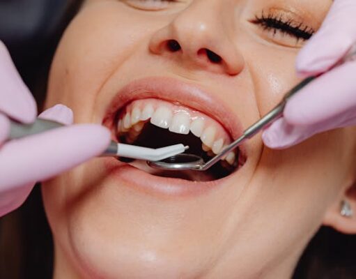 În cât timp se fac fațetele dentare? Fațetele dentare