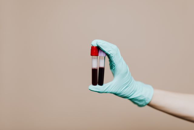 proteină-produsă-în-principal-de-ficat Fibrinogenul